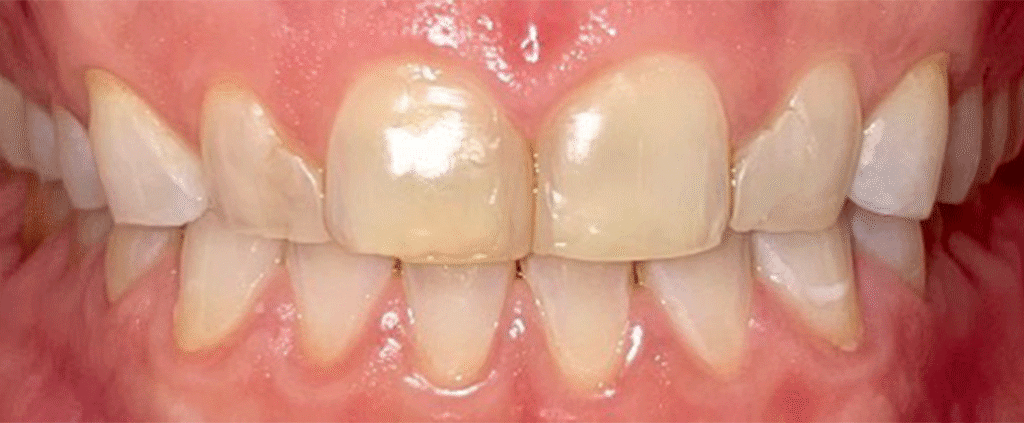 Smile before getting dental veneers at Winter Dental in Arvada, CO.