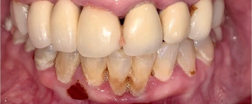 Smile before getting dental veneers at Winter Dental in Arvada, CO.