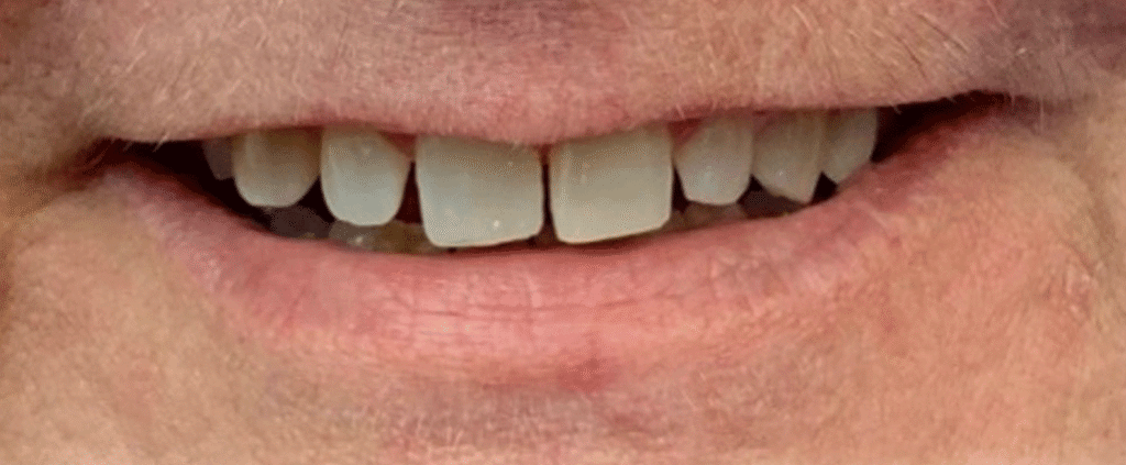 Smile before getting dental veneers at Winter Dental in Arvada, CO.